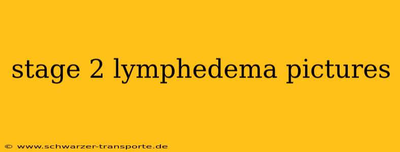 stage 2 lymphedema pictures