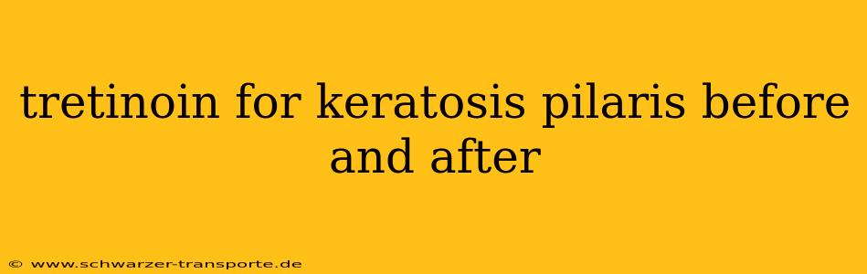 tretinoin for keratosis pilaris before and after